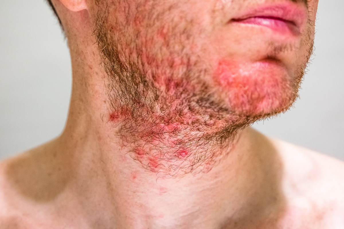 skin irritation beard